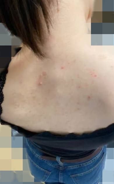 (여드름 사진 있음)내친구가 사람이면 이정도 등드름은 다 있다는데 맞아???